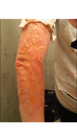 A 3rd degree gelatin burn along the arm