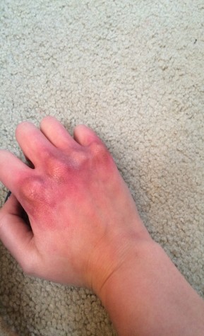 Bruised knuckles